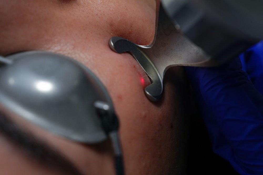 Akne tedavisinde koruyucu hekimlik önem taşıyor